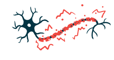 An illustration of a nerve cell showing damage to myelin along its fiber.