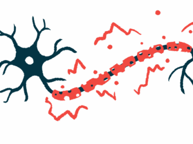 An illustration of a nerve cell showing damage to myelin along its fiber.