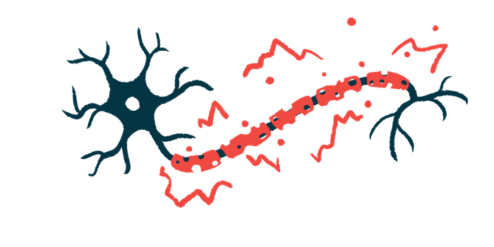 An illustration of a nerve cell showing damage to myelin along its fiber.